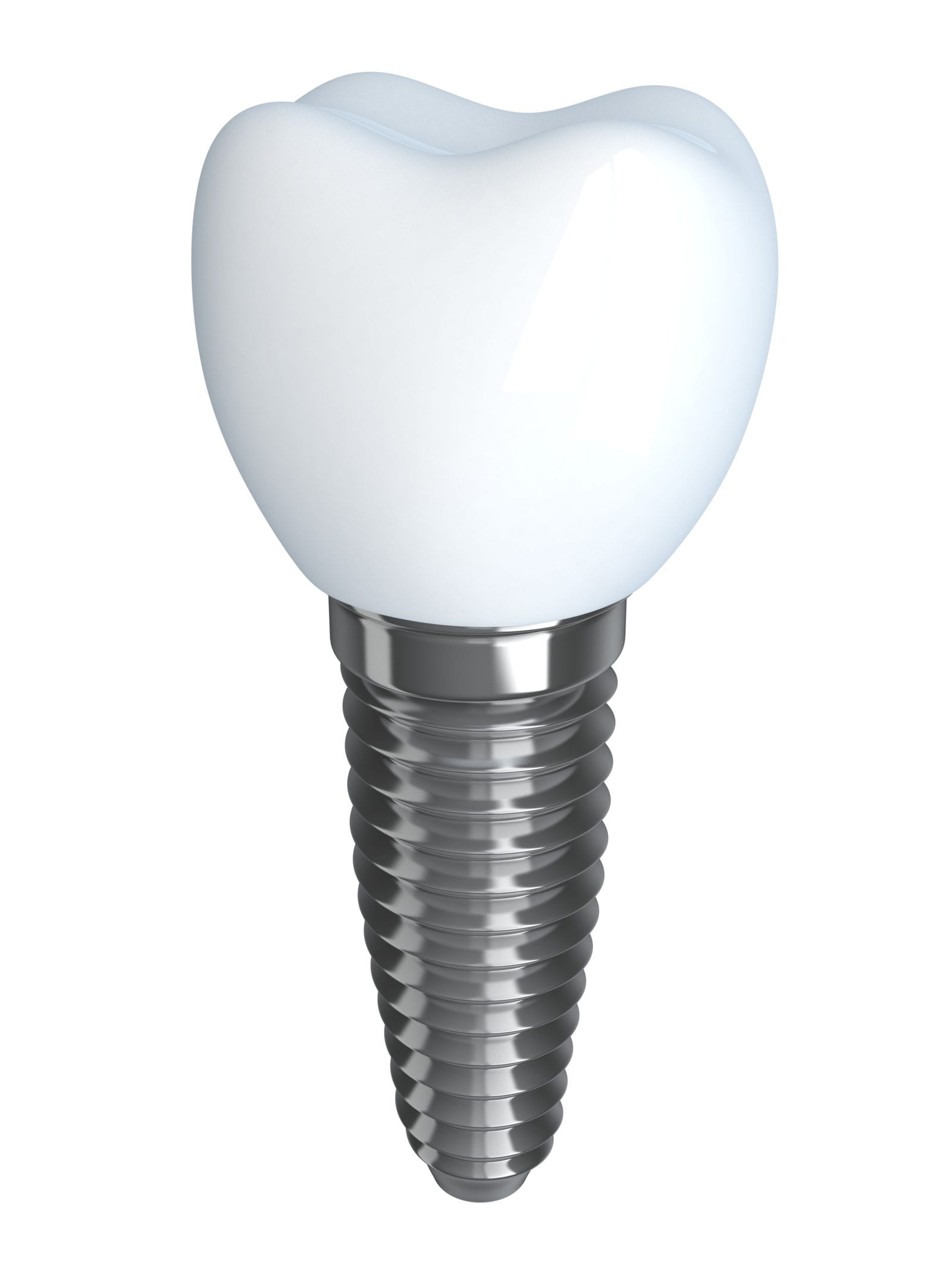 dental implant