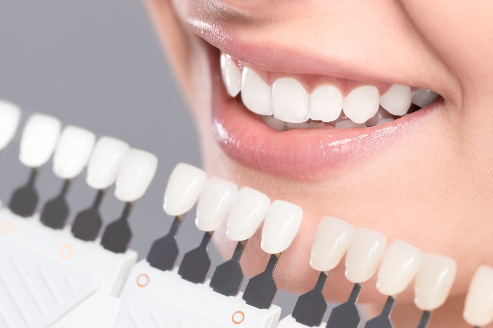 teeth whitening with shade guide