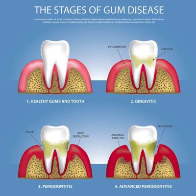 Affordable Gum Disease Treatments: Preventing Serious Dental Issues