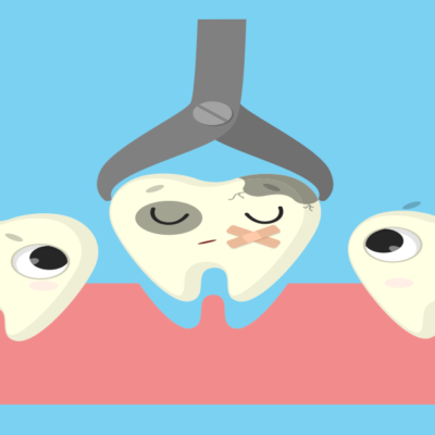 Tooth Extraction | Pulling Teeth | Services from Downtown Dental